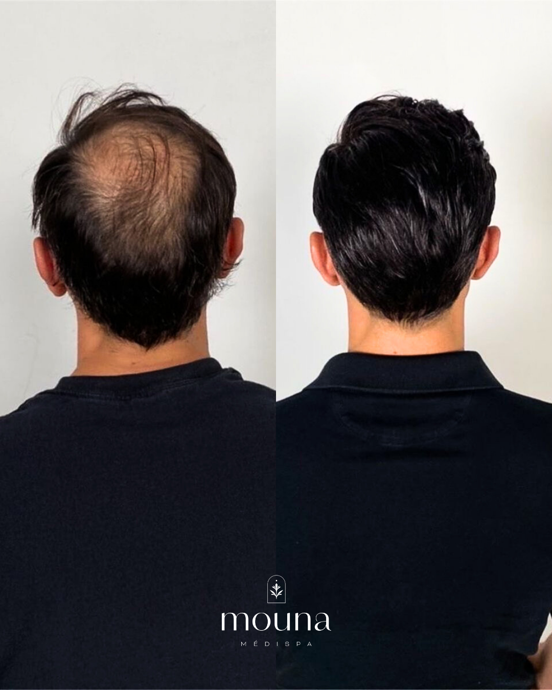Before after result