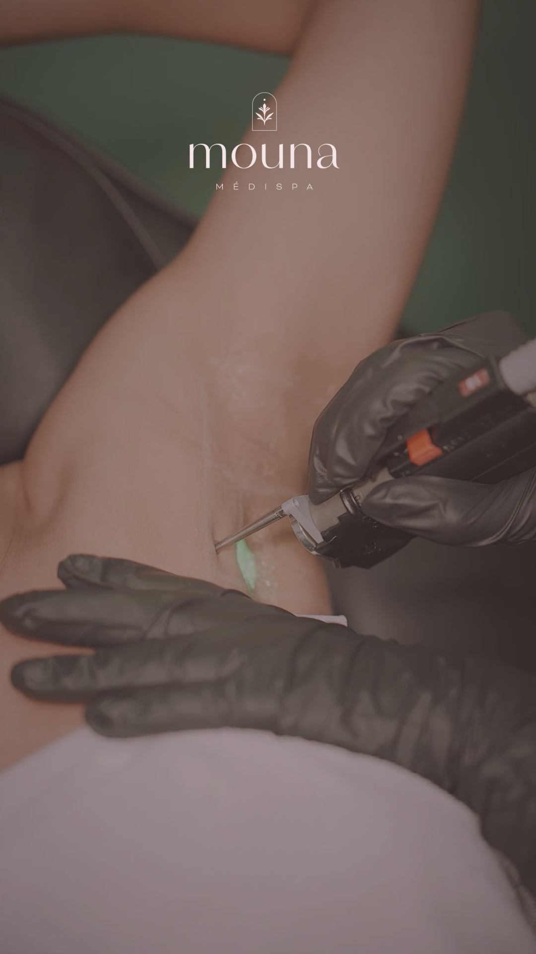 Traitement laser Elite iQ®