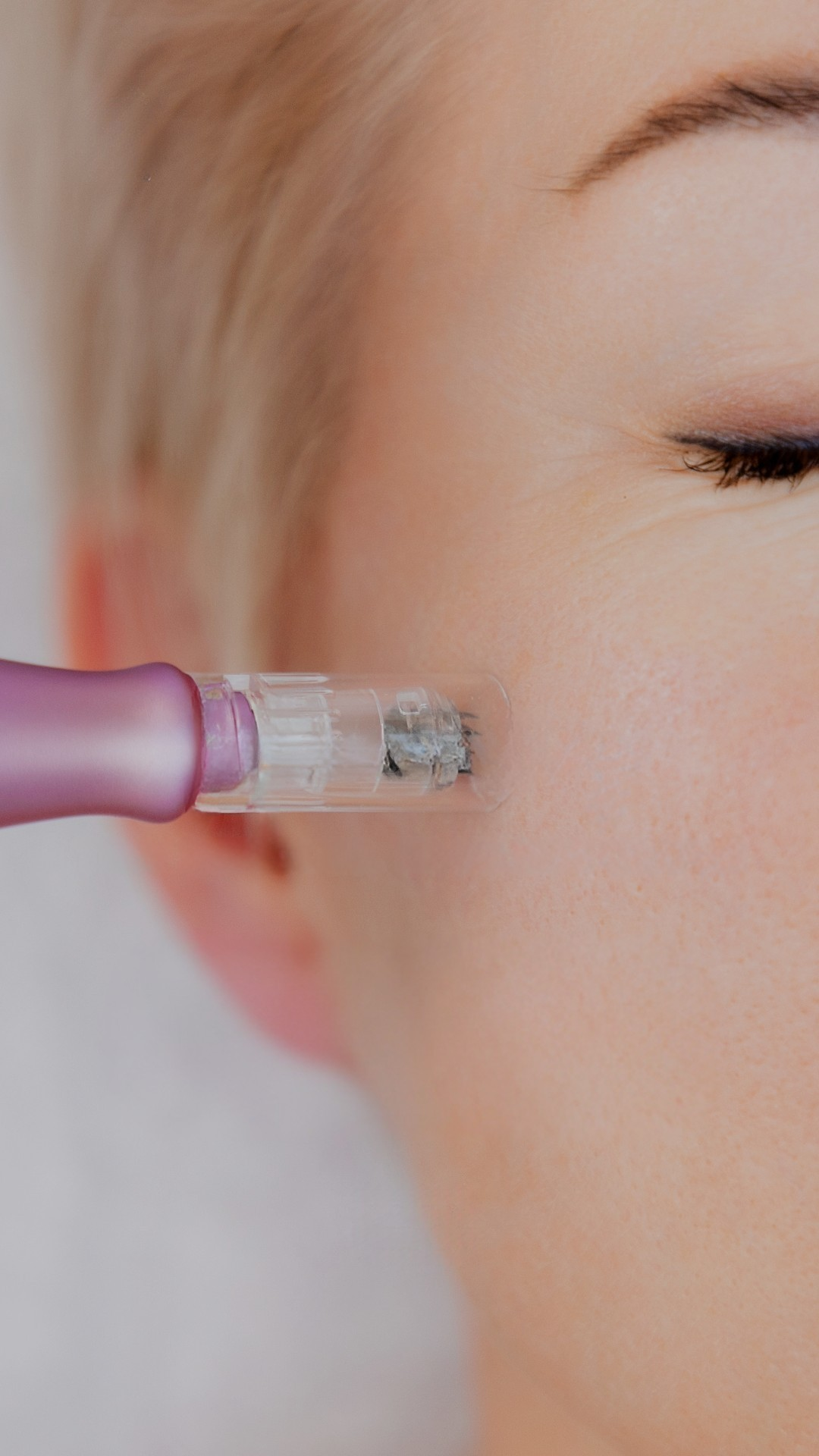 Microneedling - Mouna Medispa