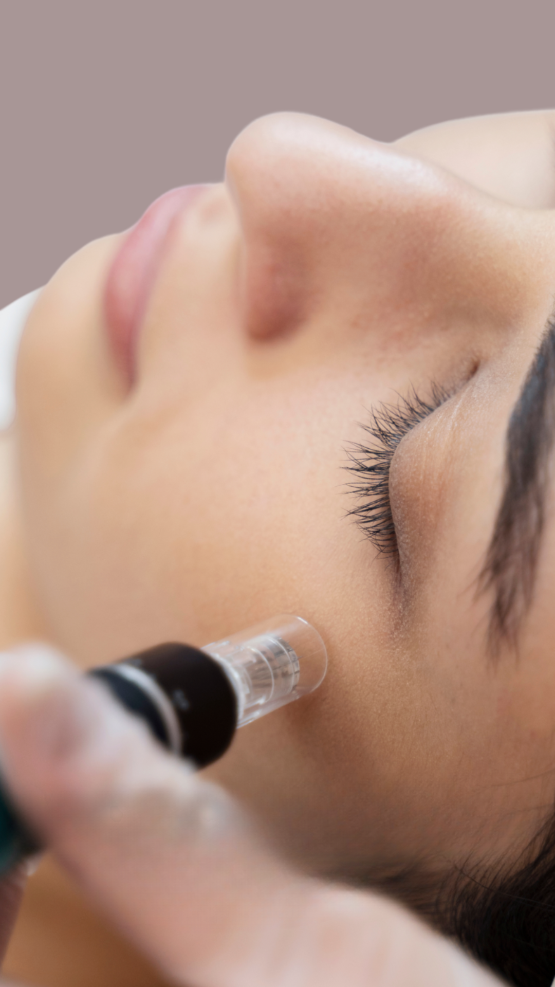 L’Action du Dermapen
