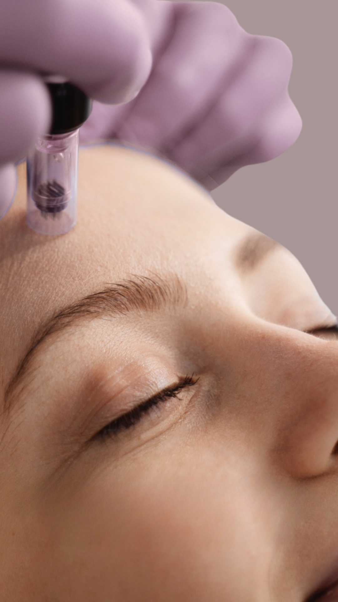 Microneedling - Mouna Medispa