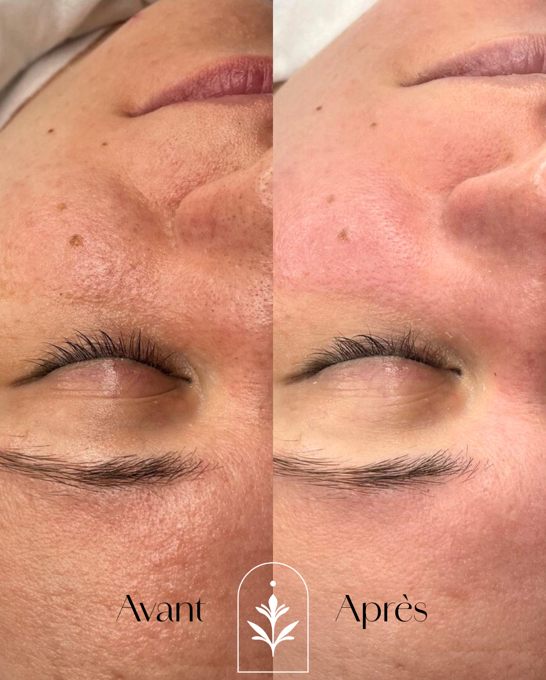 Soin & consignes post-peel