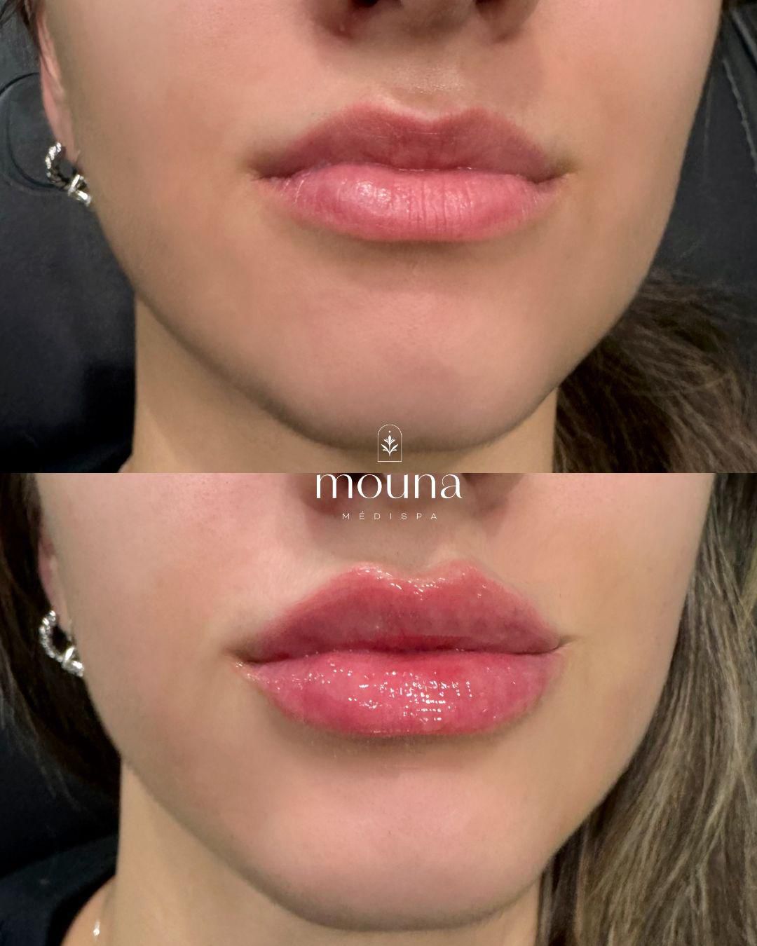 Soin Signature Hydra-P-Facial - Mouna MédiSpa